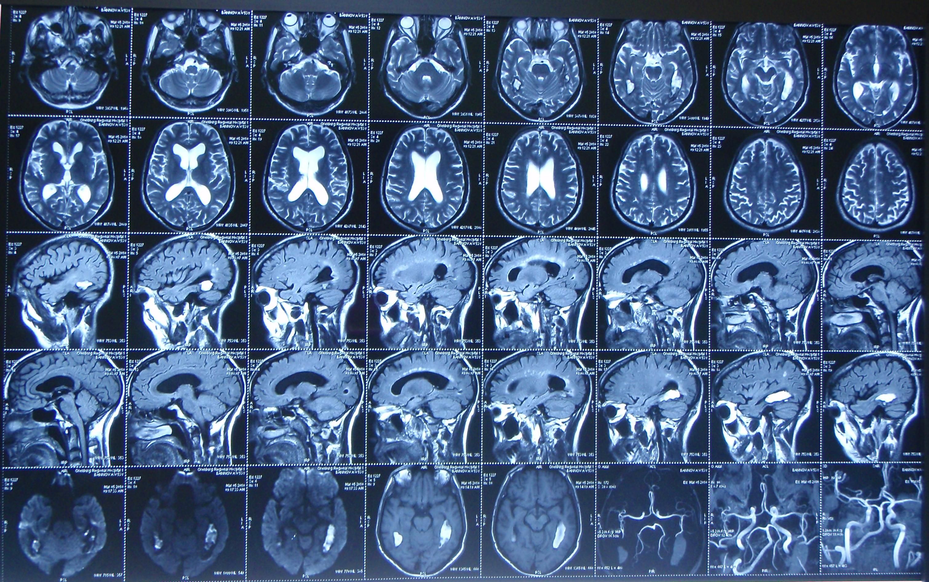 Что лучше кт головного мозга или мрт. Кт томограмма головного мозга. Компьютерная томография кт головного мозга. Магнитно-резонансная томография мрт снимки. Магнитно резонансные томограммы головного мозга.